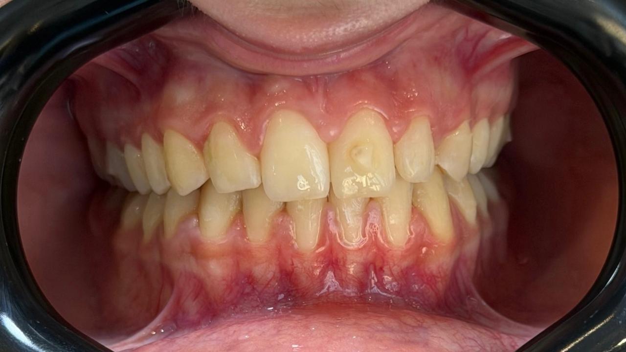 Sourire après la pose d'implants dentaires à Tanger
