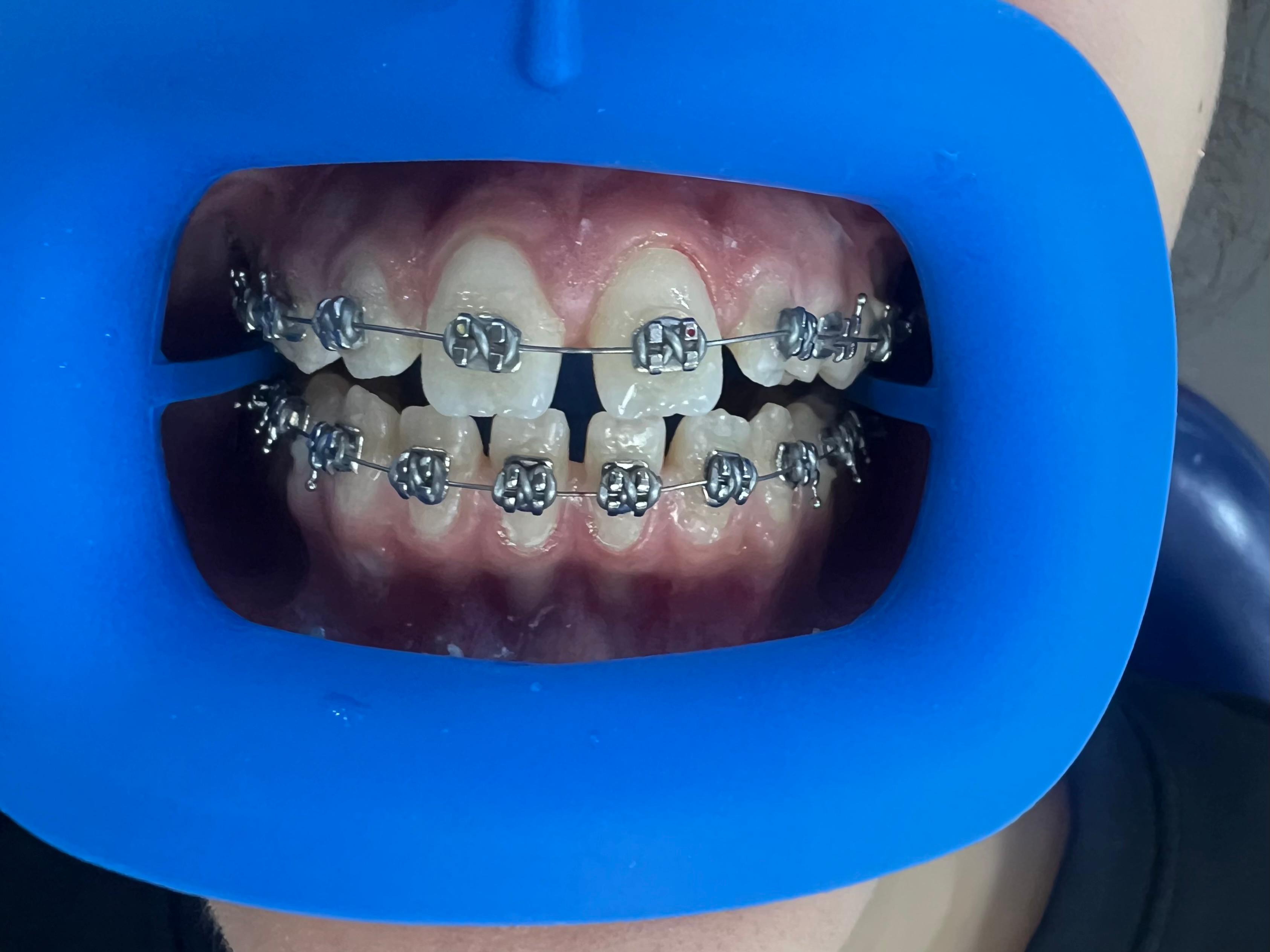 Résultat avant la pose d'implants dentaires à Tanger