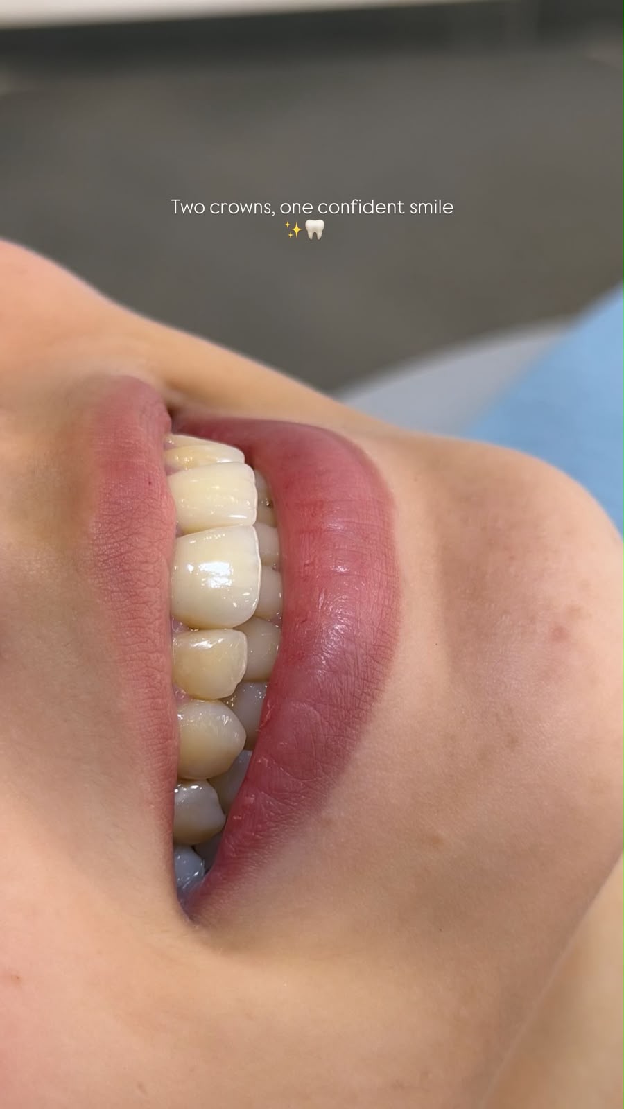 Nouveau cas clinique de soins dentaires au Centre Dentaire Dr. Sara Ben Sliman, Tanger