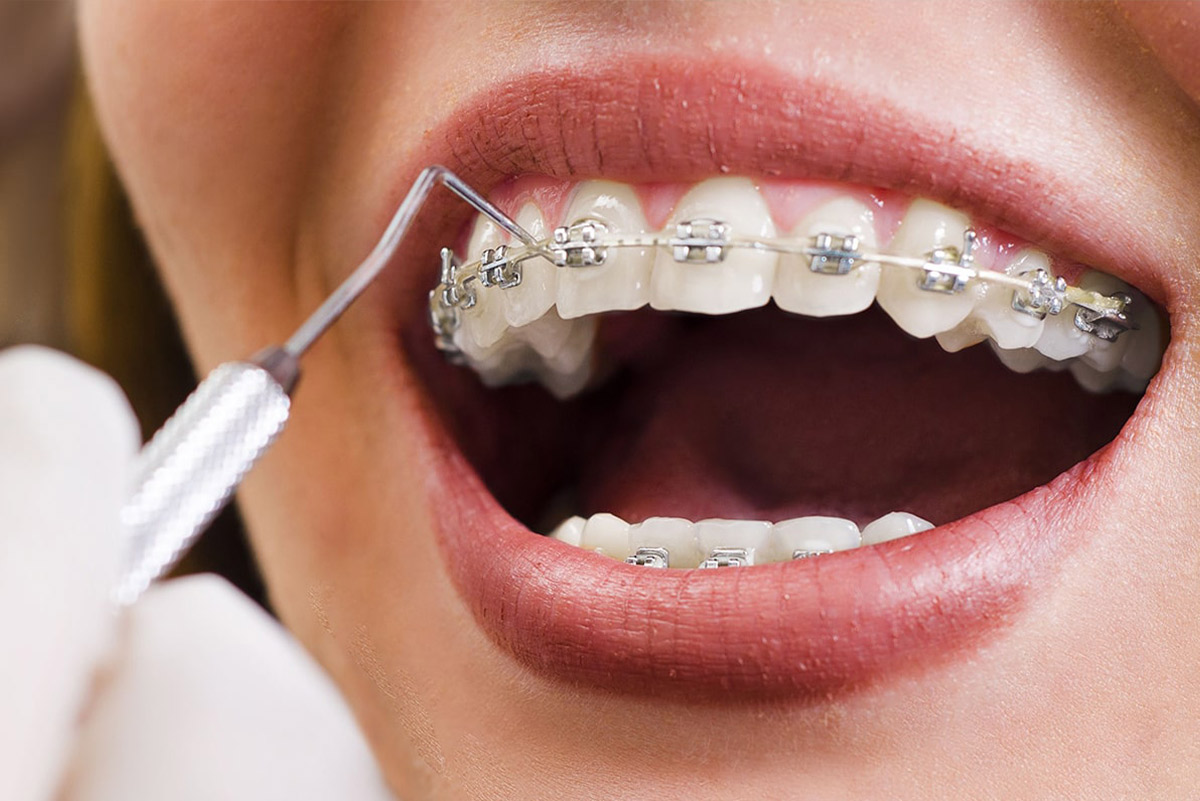 Orthodontie moderne et aligneurs transparents